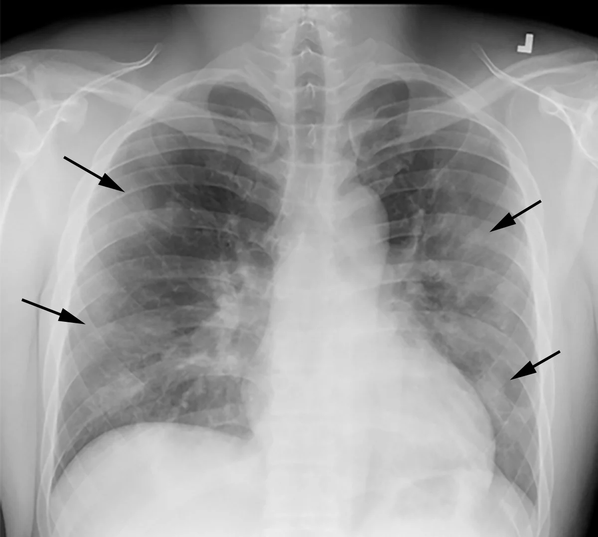 New AI Model Revolutionizes Lung Function Assessment via Chest X-Rays