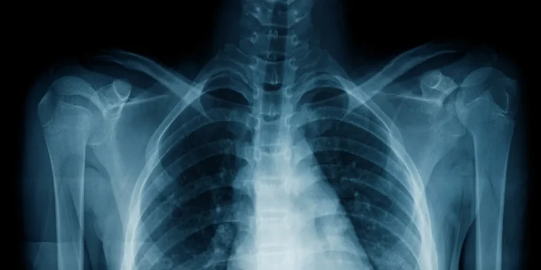 New AI Model Revolutionizes Lung Function Assessment via Chest X-Rays