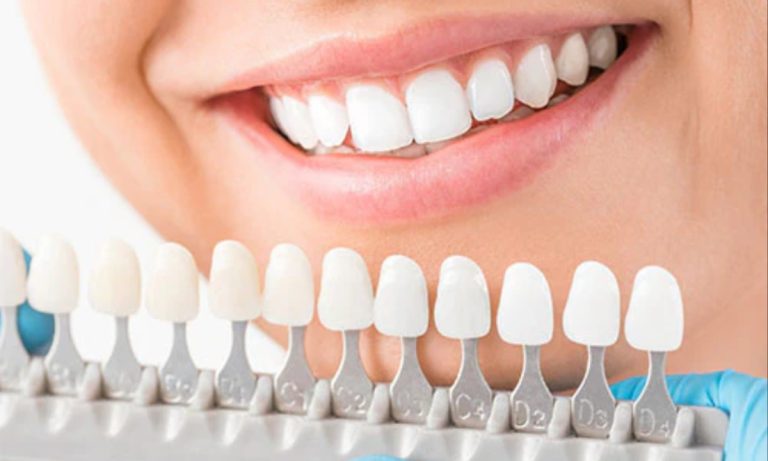 Understanding Dental Veneers Types, Benefits, and What to Expect from the Procedure