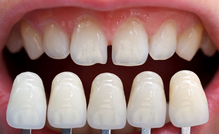 Understanding Dental Veneers Types, Benefits, and What to Expect from the Procedure