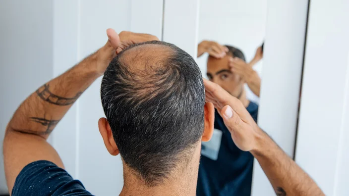 Understanding the Link Between Testosterone Replacement Therapy and Hair Loss