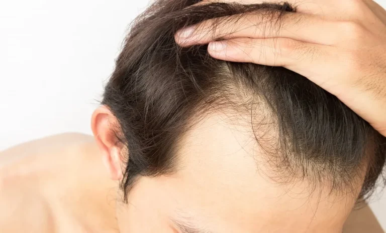 Understanding the Link Between Testosterone Replacement Therapy and Hair Loss