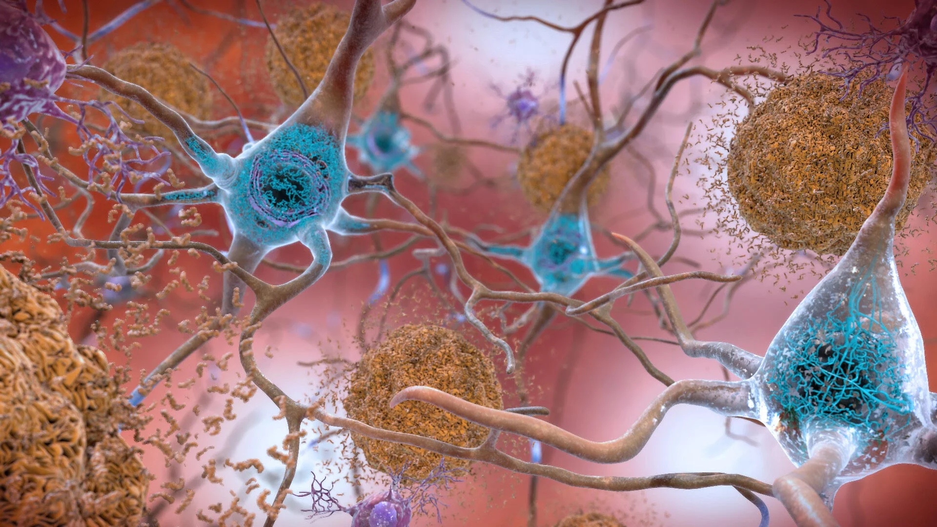 Alzheimer's Research Faces New Controversies and Theories as Focus Shifts from Beta-Amyloid