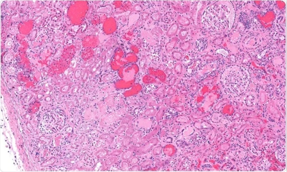 Italy Reported 68 Hemolytic Uremic Syndrome Cases in the Past Year, Predominantly in Children, With Notable Regional and Seasonal Variations