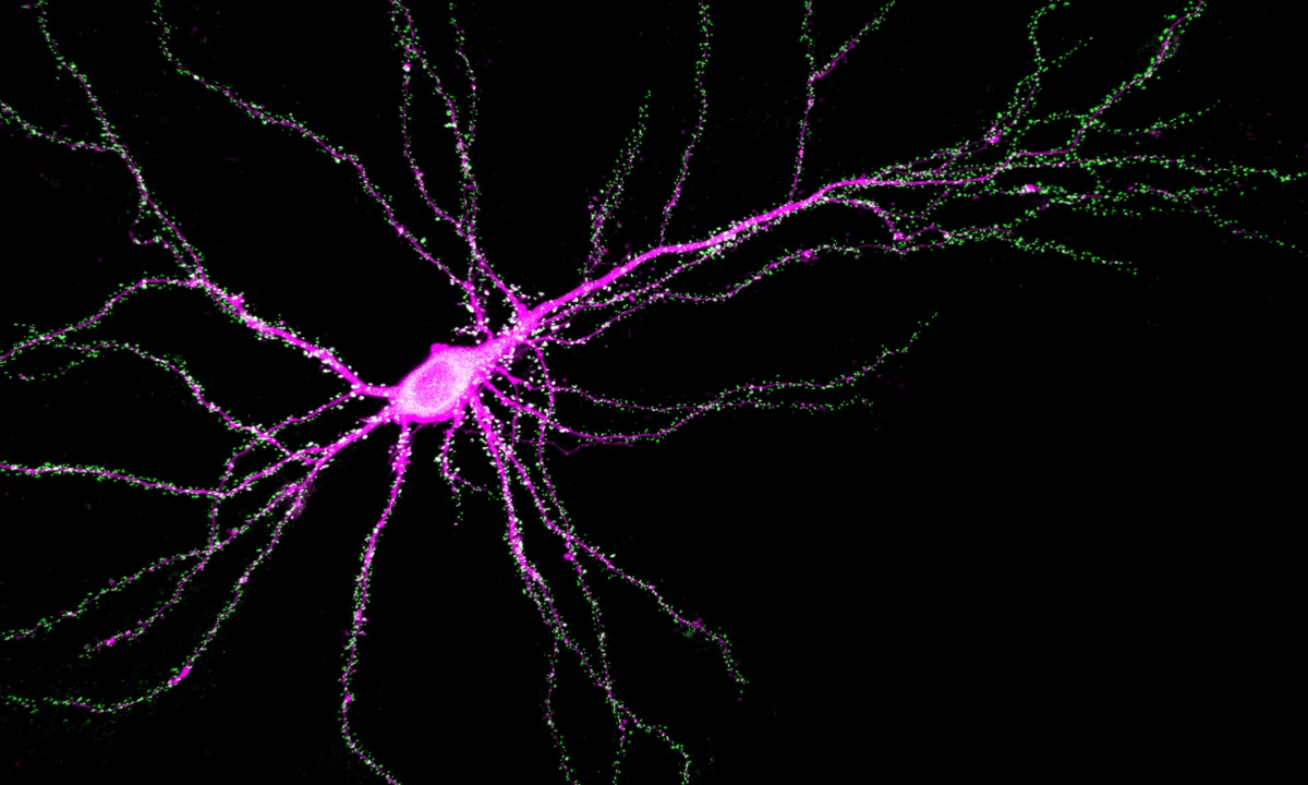 Study Links SYNGAP1 Gene Mutations to Disrupted Neuronal Development and Cognitive Disorders