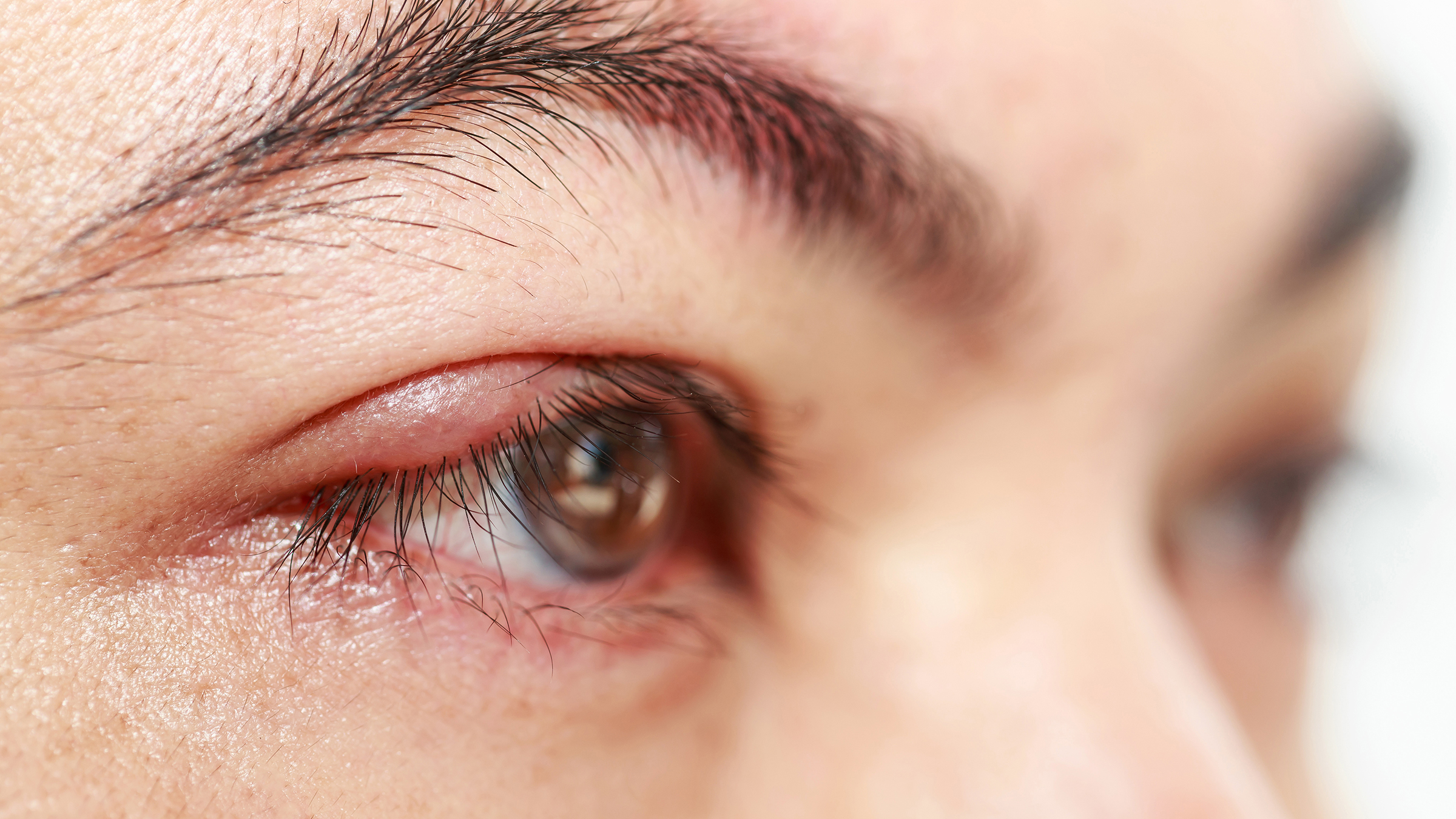 Understanding Corneal Abrasions Symptoms Treatment and Prevention