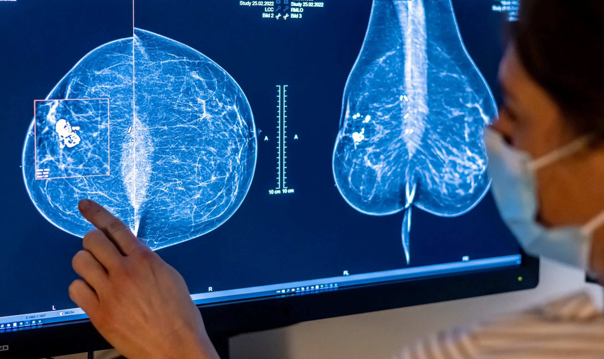 FDA Requires Mammogram Facilities to Report Breast Density to Patients Amid Coverage Concerns