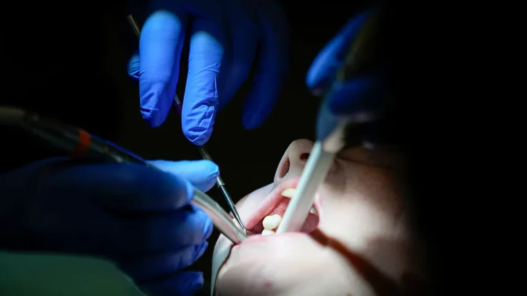 U.S. Dental Care Crisis as High Costs and Limited Insurance Coverage Leave Millions Without Essential Treatment