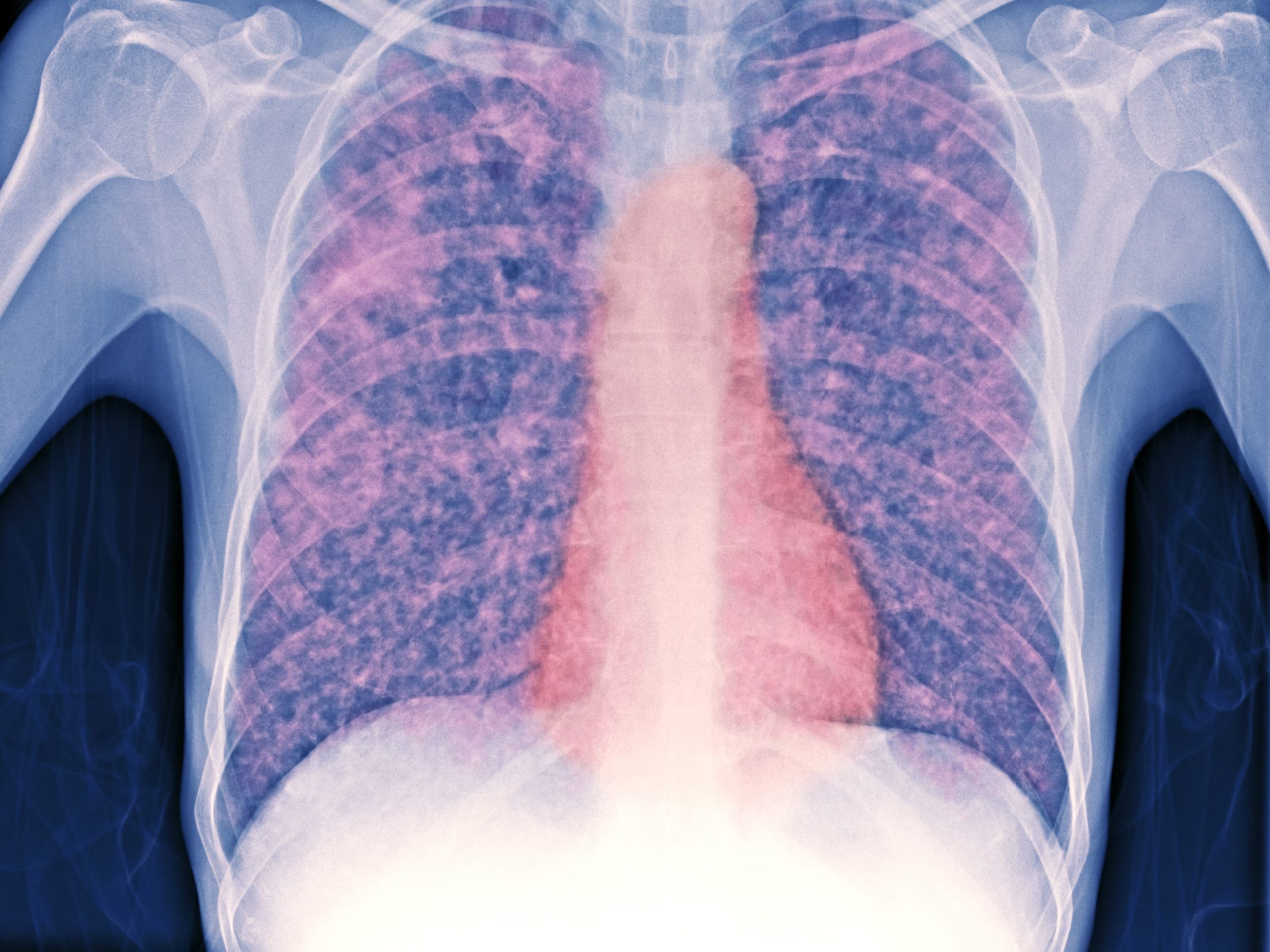 Address the Resurgence of Tuberculosis as the Leading Infectious Disease Killer Worldwide