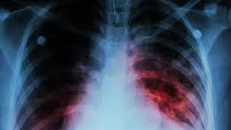 Address the Resurgence of Tuberculosis as the Leading Infectious Disease Killer Worldwide