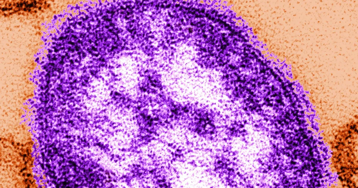 Measles Case in Monmouth County Sparks Health Alerts Following Possible Exposures