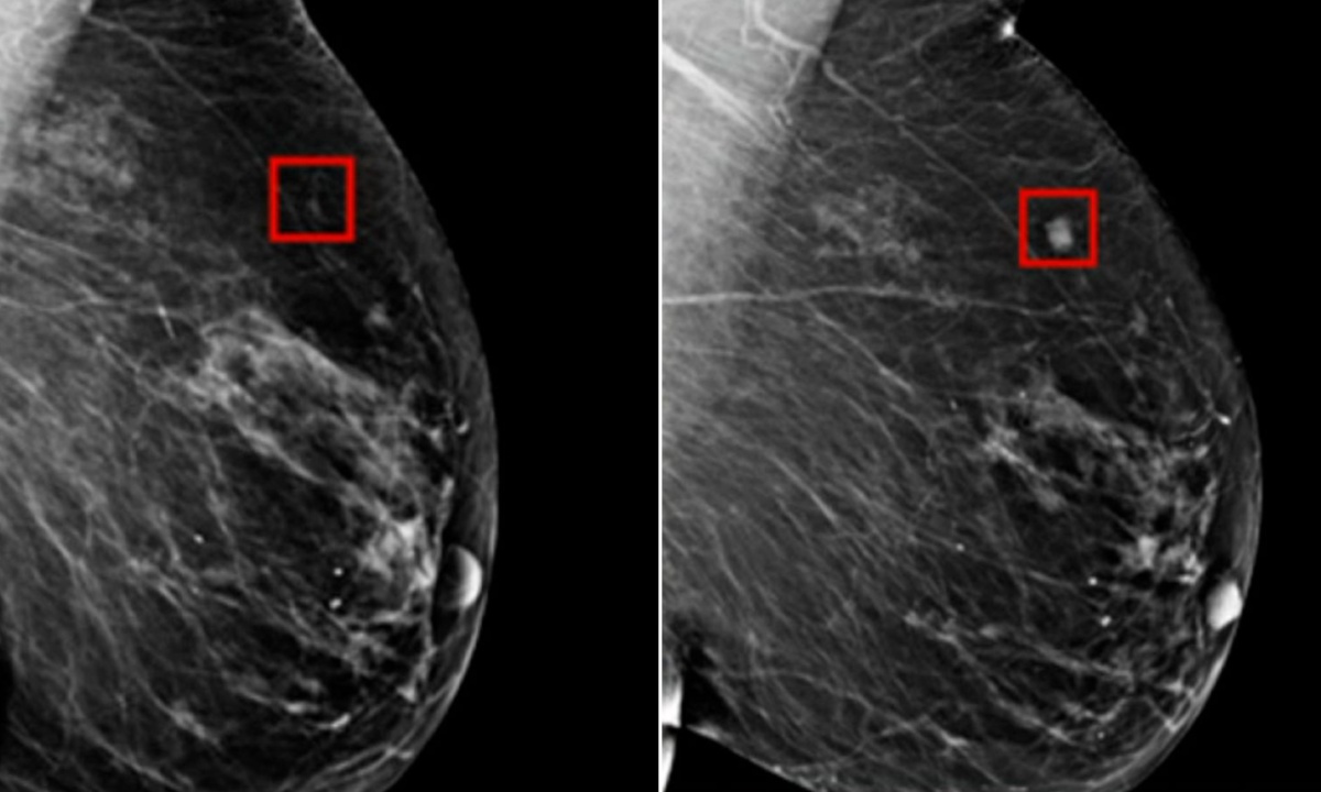 New Research Links Dense Breast Tissue to Higher Cancer Risk and Complicates Tumor Detection