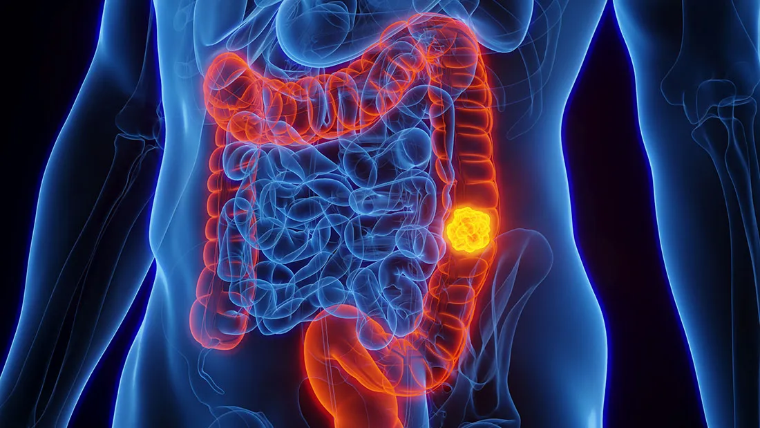 Study Reveals Rising Colon Cancer Rates Among Younger Adults, Highlighting Key Risk Factors and Urging Early Screening