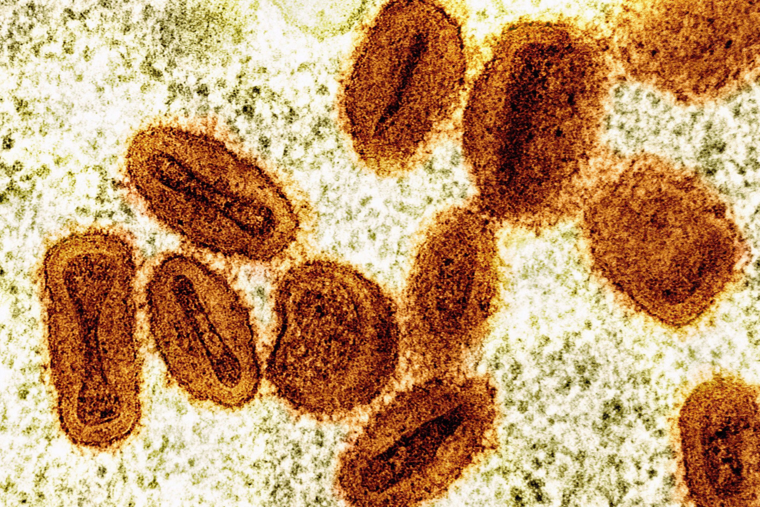 First U.S. Case of Severe Monkeypox Strain Detected in California Following Travel to Africa