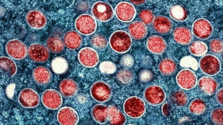 First U.S. Case of Severe Monkeypox Strain Detected in California Following Travel to Africa