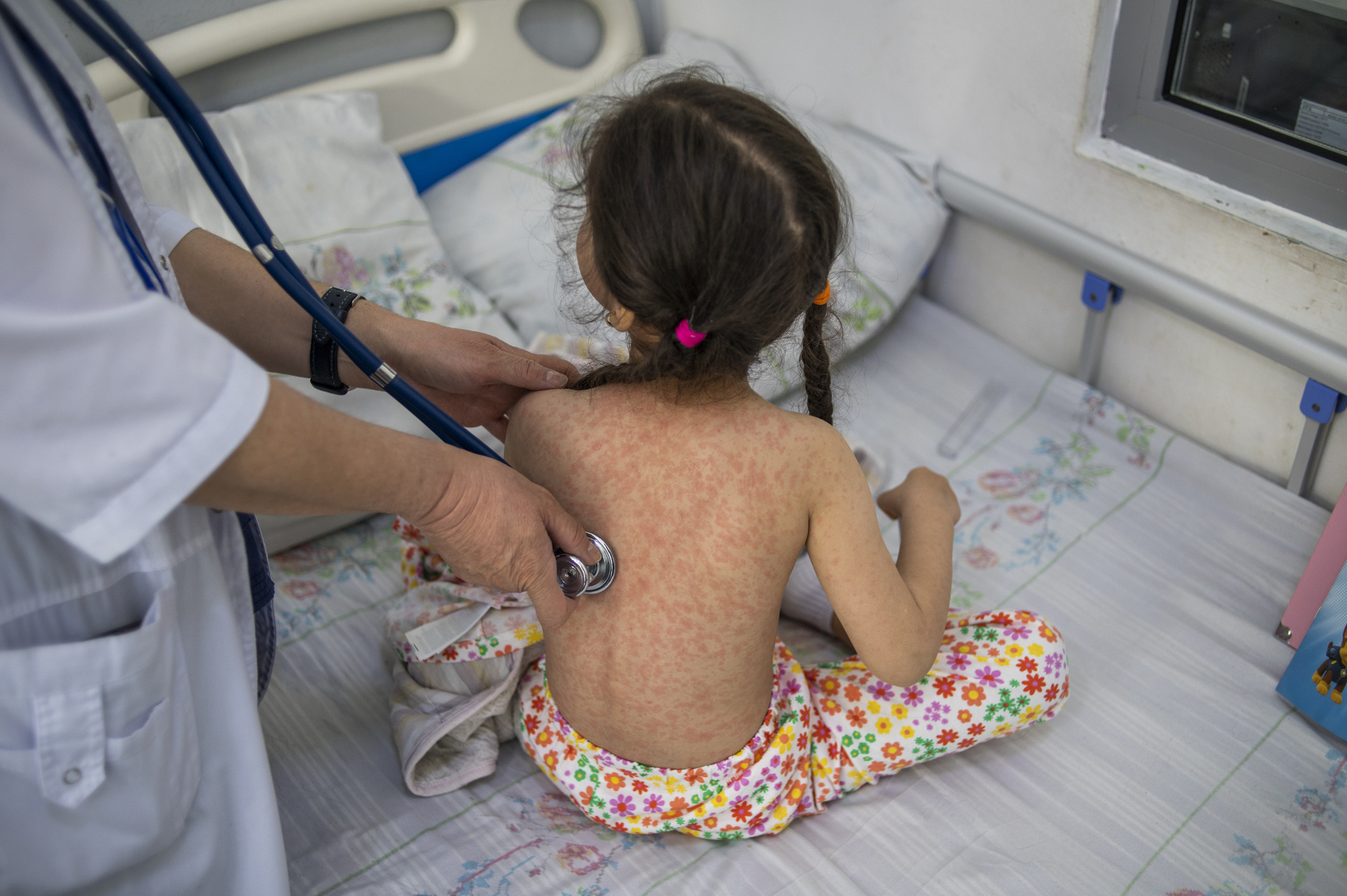 Global Measles Cases Surge 20% in 2023, Highlighting Urgent Need for Increased Vaccination Efforts