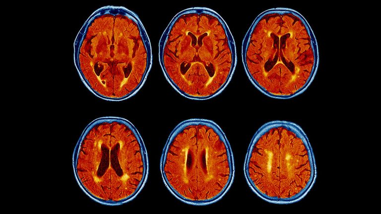 Nilotinib Shows Promise in Reversing Dementia Symptoms, Offering New Hope for Neurodegenerative Disease Treatment