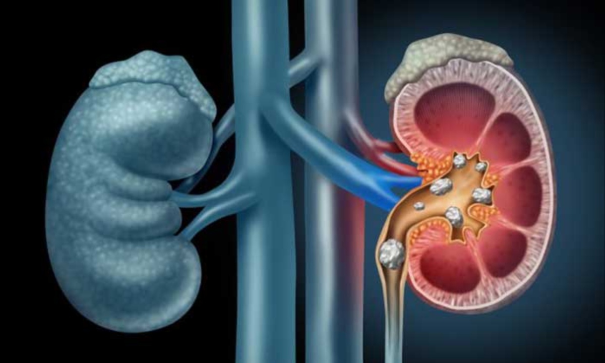 Research Shows SGLT-2 Inhibitors Can Help Prevent Kidney Stones and Improve Diabetes Management