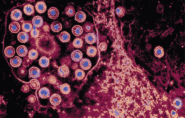 Revealing How Herpes Simplex Virus Type 1 Invades the Brain and Affects Neurodegenerative Disease Progression