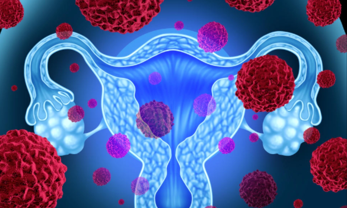 USPSTF Proposes Shifting to HPV Testing as Primary Method for Cervical Cancer Screening